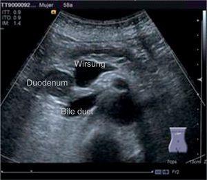 Abdominal ultrasound showing dilatation of the main pancreatic duct and the bile duct.