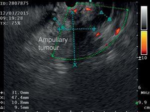 Endoscopic ultrasound showing dilatation of the pancreatic duct and the dimensions of the ampullary tumour.