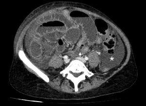 Intravenous contrast enhanced computed tomography axial imaging of the abdomen. Dilation of small intestine loops and presence of ascitic fluid (asterisk). Abnormal position of caecum, located mid line (arrow).