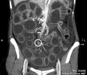 Ricostruzione coronale della tomografia calcolata calcolata a contrasto endovenosa dell'addome. Dilatazione generale di piccoli anelli intestini e presenza di fluido ascitico. Gruppi di navi mesenterici a livello di assi di Volvolus (cerchio), responsabile per l'occlusione.