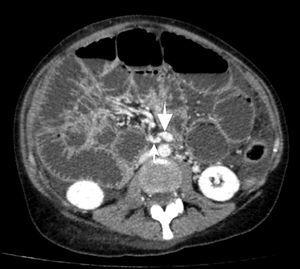 contraste intraveineux amélioré axial tomodensitométrie imagerie de L'abdomen. Inversion des vaisseaux mésentériques, avec une artère mésentérique supérieure (flèche mince) située à droite de la veine mésentérière supérieure (flèche épaisse).
