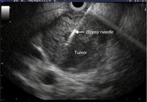 Endoscopic ultrasound image with a well-defined pancreatic mass and biopsy needle for obtaining a sample of the lesion.