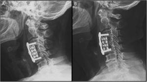(A) Immediate postoperative X-ray. (B) X-ray at 4 years postoperatively.