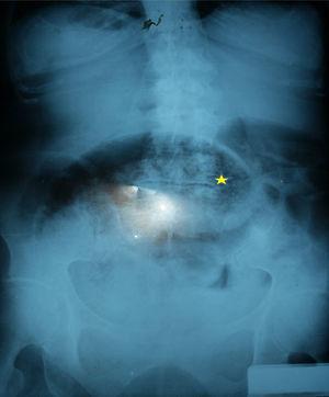 X-ray of the abdomen with data suggestive of volvulation (star).