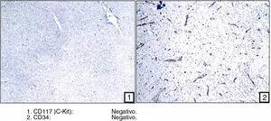 Demonstration of intraluminal tumour. Formalin-fixed and paraffin-embedded immunohistochemcial staining of tissue sections.