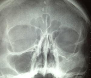 Radiographie simple en vue de Waters montrant une asymétrie avec hyperdensité au niveau du sinus maxillaire gauche avec renforcement osseux et hypoglobus.