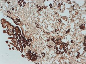 Mesothelioma Immunohistochemistry - Pathology Outlines - Diffuse