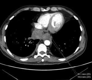 Chest computed tomography: mass in the posterior–inferior mediastinum obliterating the oesophagus and surrounding the inferior vena cava.
