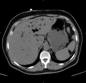 Abdominal CT scan without contrast. Axial slice: air bubbles in the gastric wall and diffuse wall thickening. Abundant gas in the liver parenchyma and in the portal system.