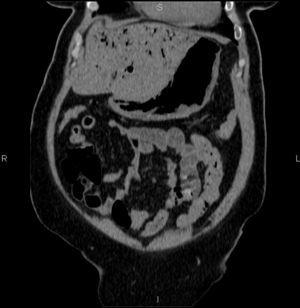 Abdominal CT scan without contrast. Coronal reconstruction: emphysematous gastritis and portal system.