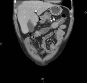Computed tomography (coronal slice). The polyp causing the intussusception can be seen (→).
