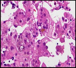 Hepatocytes with presence of intracytoplasmic bile pigment (haematoxylin–eosin).