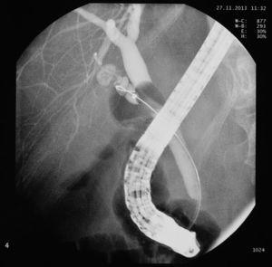 Cholangiography with Fogarty balloon and calculi in the remnant.