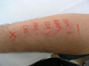 Allergy test carried out 2 months after the anaphylactic shock.