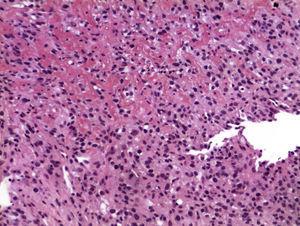 Biopsy of duodenal tumour consistent with metastasis of clear cell renal cell carcinoma with sarcomatoid differentiation of the primary tumour, characterised by grouping of fusiform cells with an interlinked and storiform pattern, with nuclear pleomorphism.