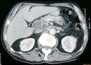 Abdominal CT scan: cystic lesion containing septa and measuring 5×5cm in the head of the pancreas.