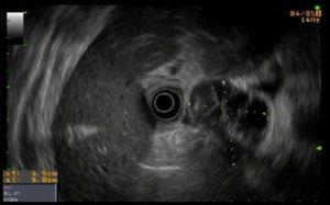 Endoscopic ultrasound: hypoechoic and heterogeneous pancreatic cystic lesion measuring 5×4cm.