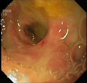 Gastroscopy: the pancreas.