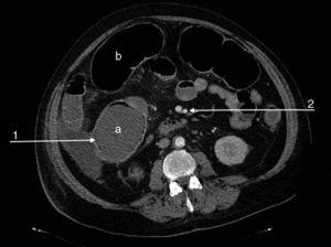 Abdominal CT angiography image showing significant dilation of the caecum (a) and transverse colon (b). Pneumatosis is visible in the wall of the caecum (arrow 1) with patent mesenteric artery and vein (arrow 2).