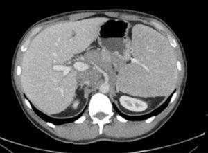 Mass covering the retroperitoneal vessels.