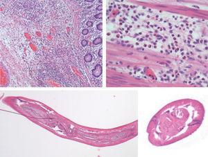 Eosinophilic colitis with significant oedema and inflammatory infiltrate, with the presence of eosinophils. Longitudinal and cross section of the parasite.