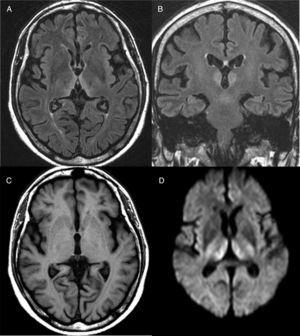 Brain magnetic resonance image from a patient with Wernicke's encephalopathy. Bilateral thalamic hyperintensities around the third ventricle are seen on fluid attenuation inversion recovery (FLAIR) weighted axial (A) and coronal (B) images. (C) T1-weighted axial image showing no lesions. (D) Diffusion-weighted (DWI) axial image showing hyperintensity in bilateral symmetric thalami.