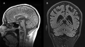 Brain MRI of a patient with alcohol-related cerebellar degeneration. T1-FLAIR (A) sagittal and (B) coronal images showing predominantly cerebellar vermian atrophy.
