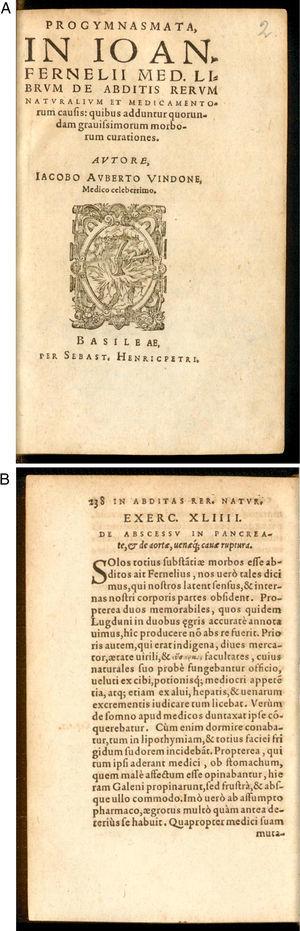 (A) and (B) Book published by Iacobo Auberto Vindone in 1579 describing the post-mortem findings of an alcoholic patient with pancreatic necrosis for the first time.