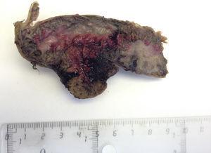Resection specimen showing the presence of the ectopic pancreatic tissue in contact with the bowel lumen.
