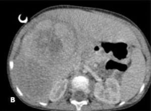 CT image of the abdomen at diagnosis.