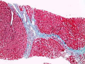 Section of liver biopsy with Masson's trichrome staining at 100× showing fibrosis bridges.