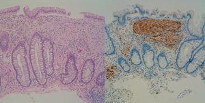 On the left, photomicrograph of a ganglioneuromatous polyp with haematoxylin–eosin staining. On the right, immunohistochemistry for S100 that marks the neural component.