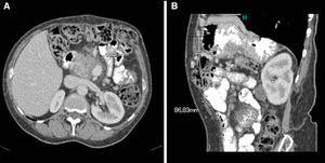 Axial (A) and parasagittal (B) view of abdominal CT: subcostal hernia before repair.