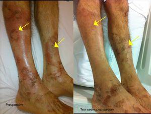 Necrolytic migratory erythema. Psoriasiform lesions on the patient's legs before surgery, and two weeks after the intervention when the lesions were found to have disappeared.