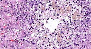Around the centrilobular vein, hepatocyte necrosis can be seen with hepatocyte loss and presence of inflammatory cells, including macrophages with ceroid pigment.