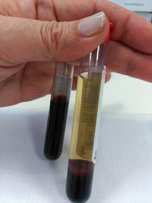Haemolysed serum (left) compared to normal serum.