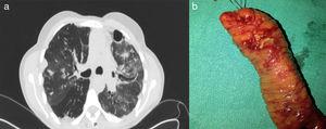 (a) Computed tomography (CT) scan of the thorax. Signs of fibrothorax with patchy honeycomb pattern, and increase in density due to possible left interstitial pneumonia. Small cylindrical bronchiectasis and bullous pattern with some subpleural bullae. (b) Surgical specimen. Segment of ileal resection with macroscopic evidence of ulcers in the surgical specimen.