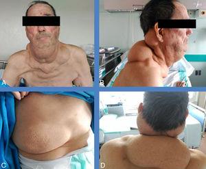 (A–D) Different views of the patient, where lipomas can be seen with special emphasis, but also on the chest (C).