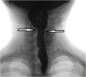 Barium swallow showing the post cricoid web.