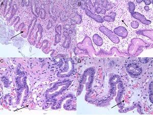 Histological image of PHG. Staining performed with haematoxylin and eosin. (A and B) The arrows indicate: congestive and dilated capillaries at 200× magnification. (C and D) The arrows indicate: congestive and dilated capillaries at 400× magnification.
