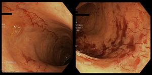 Erythematous longitudinal lines with mucosal bleeding in the ascending and proximal transverse colon.