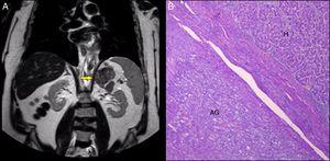 (A) MRI of metastasis in the left adrenal gland (arrow). (B) Haematoxylin–eosin staining of hepatocellular carcinoma (H) metastasis adjacent to normal adrenal tissue (AG).