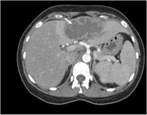 Axial CT-scan showing a rounded, well-defined mass located in liver (arrow). It is possible to identify a central cavity filled with low-density fluid with internal septations. A peripheral enhancing rim corresponding to the abscess wall as well as a peripheral zone of surrounding oedema are seen. Amebic abscess are typically subcapsular single lesions located in the right liver lobe, although in this case is seen in the left lobe.
