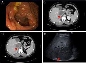 A) Sores observed in the colonoscopy prior to admission. B and C) Axial CT slices showing the liver abscess (arrow). D) Ultrasound image showing the abscess prior to drainage (arrow).