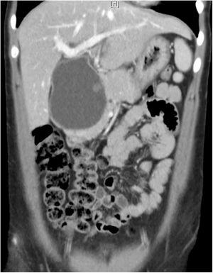 CT image of the cyst.