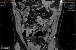 Perforated diverticulum; coronal slice. The image shows a diverticulum with signs of inflammation and perforation at the preterminal ileum in an abdominal CT scan.