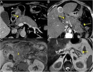 Different forms of presentation and evolution of type 1 AIP. A) CT scan image, diffuse increase in pancreatic size (continuous arrow) without associated peripancreatic inflammatory changes. B) CT scan image, diffuse increase in pancreatic size (continuous arrow) with inflammatory changes in the peripancreatic fat (dashed arrow), indistinguishable from acute pancreatitis. C) MRI image, enhanced sequence in T1 with contrast, fibrotic tissue in pancreatic topography (asterisk). D) MRI image, enhanced in T2, severe pancreatic atrophy (continuous arrow) in a patient with endocrine and exocrine pancreatic insufficiency.