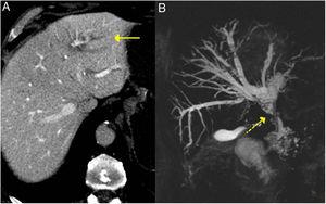 IgG4-related sclerosing cholangitis. A) CT scan image: dilation of the left intrahepatic bile duct is observed (continuous arrow). B) MRI cholangiography image: dilation of the left and right intrahepatic and extrahepatic bile ducts is observed, with stenosis in the middle third of the bile duct (dashed arrow).