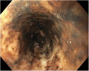 Endoscopic image of medial oesophagus showing necrotic oesophageal mucosa spreading proximally from the distal oesophagus.