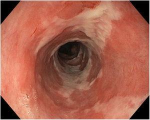 Endoscopic image of medial oesophagus showing oesophageal mucosa in process of re-epithelialisation with patchy areas of fibrin and normal mucosa.